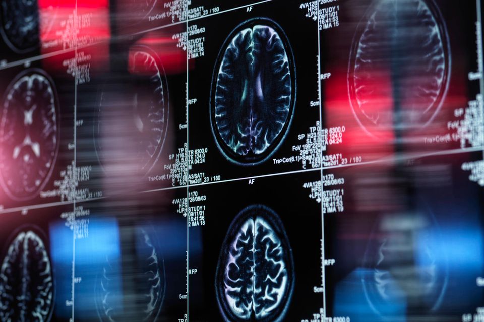 Magnetresonanzaufnahmen eines menschlichen Gehirns. In Deutschland leben rund 1,8 Millionen Menschen mit Demenz.